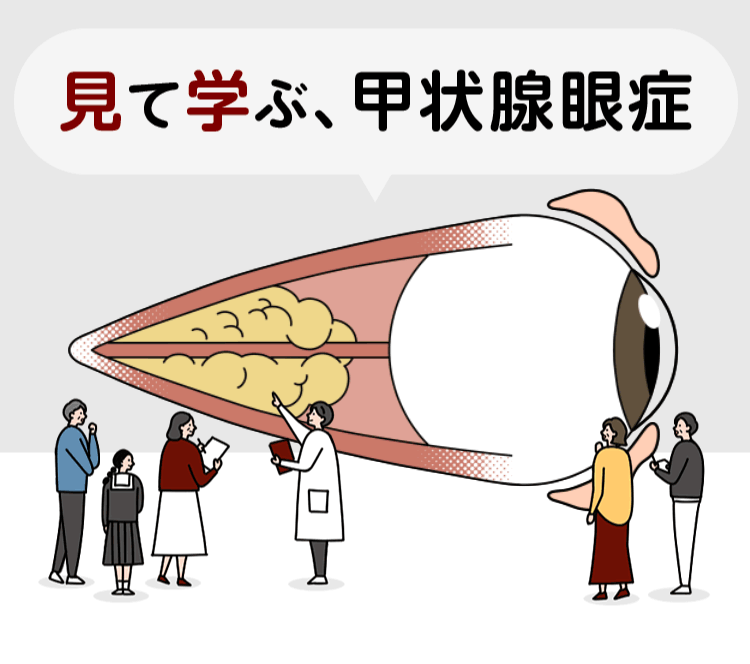 見て学ぶ、甲状腺眼症