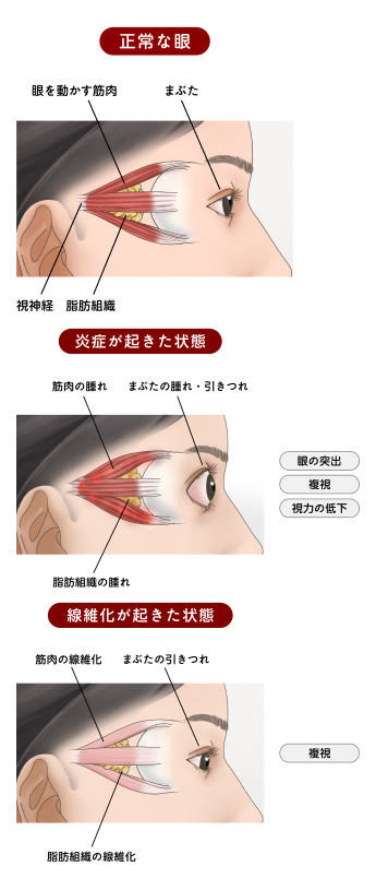 図：甲状腺眼症の症状が起こるメカニズム