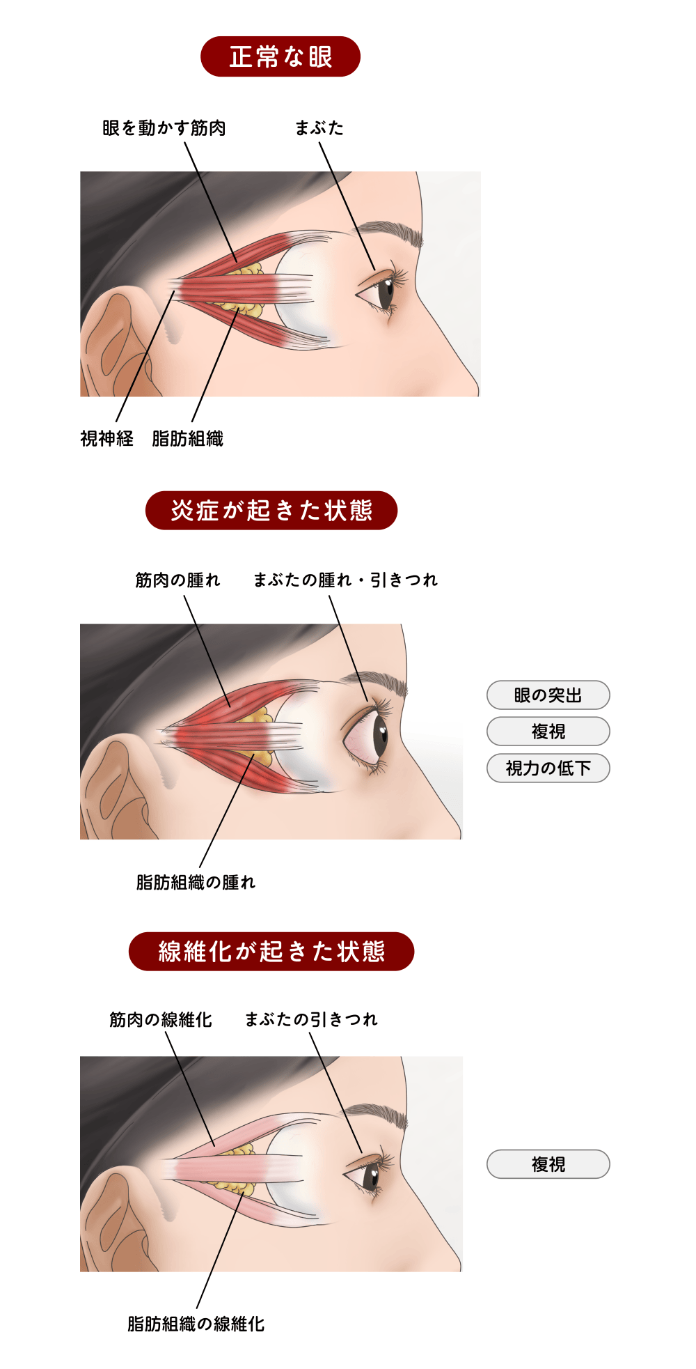 図:甲状腺眼症の症状が起こるメカニズム
