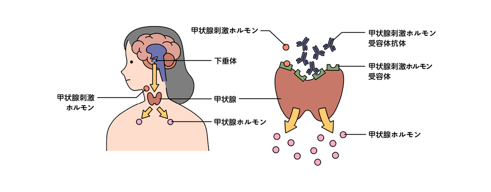図:バセドウ病が起こるメカニズム