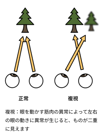 ものが二重に見える（複視）イメージ