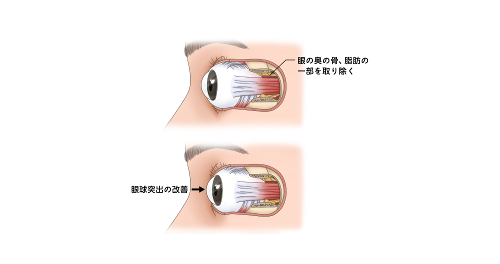 図:眼窩減圧術