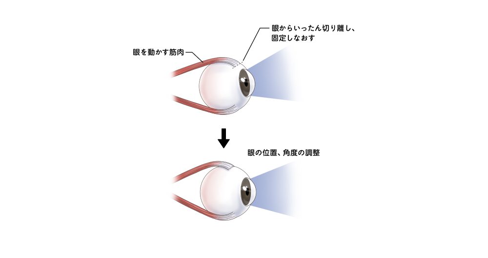 図:斜視手術