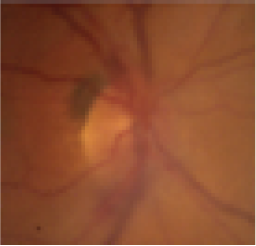 圧迫性視神経症を起こした甲状腺眼症の眼底写真